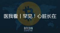 医我看丨罕见！心脏长在右胸膛！珠海成功开展首例“右位心”房颤射频消融术