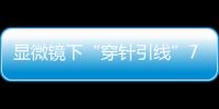 显微镜下“穿针引线”7小时！金湾这家医院成功帮患者保住断肢